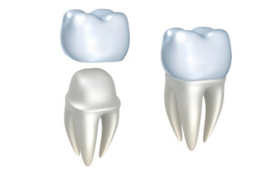 capsula corona dentale