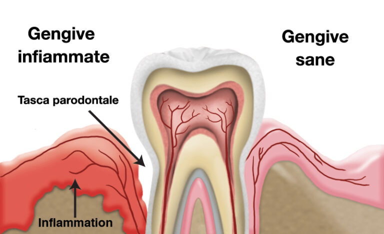 tasca parodontale piorrea