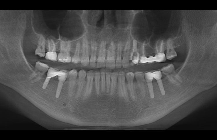 Elastici separatori denti - Fanno male? Info e vantaggi