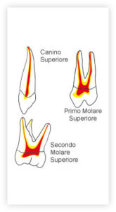 Devitalizzazione dentale